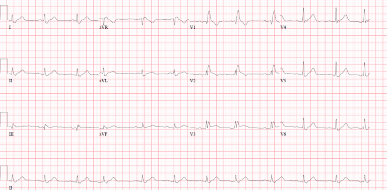 Anterior STEMI with RBBB - Cardio Guide