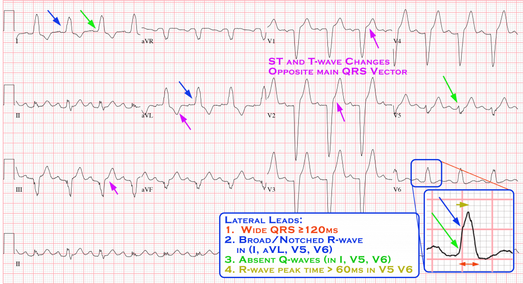 Bundle Branch Blocks - Cardio Guide