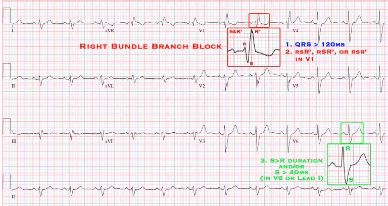 Bundle Branch Blocks - Cardio Guide