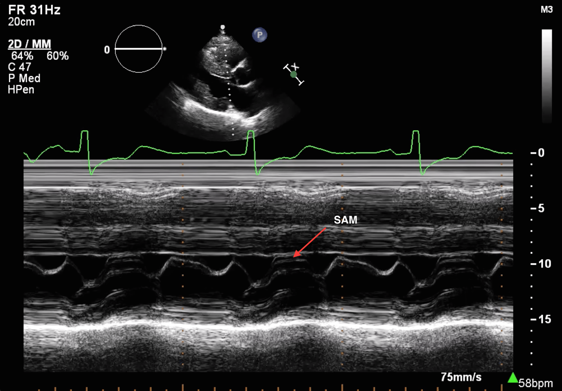 Systolic Anterior Motion Sam Of The Posterior Mitral - vrogue.co