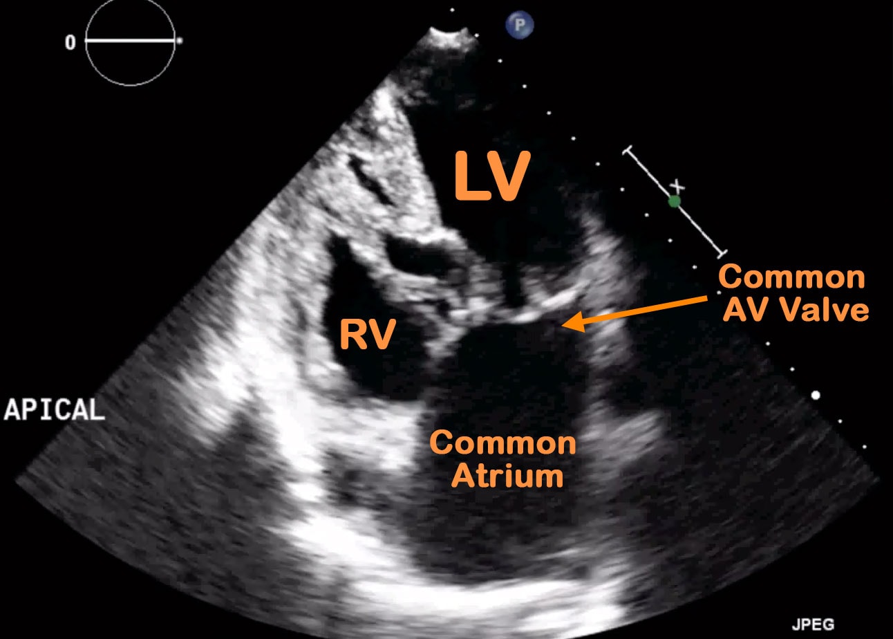 Complete AV Septal Defect - Cardio Guide