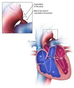 Aortic Coarctation - Cardio Guide