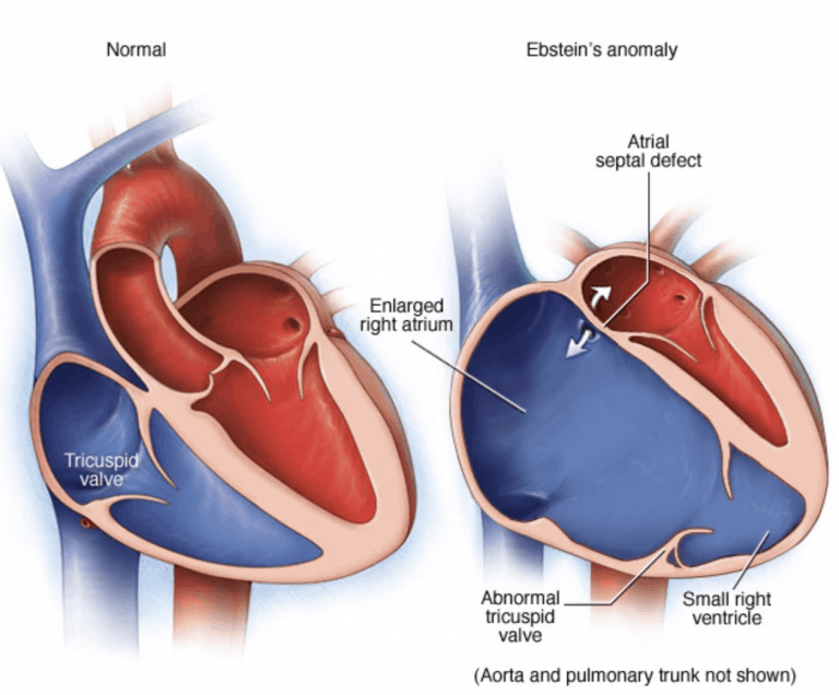 Ebstein’s Malformation - Cardio Guide