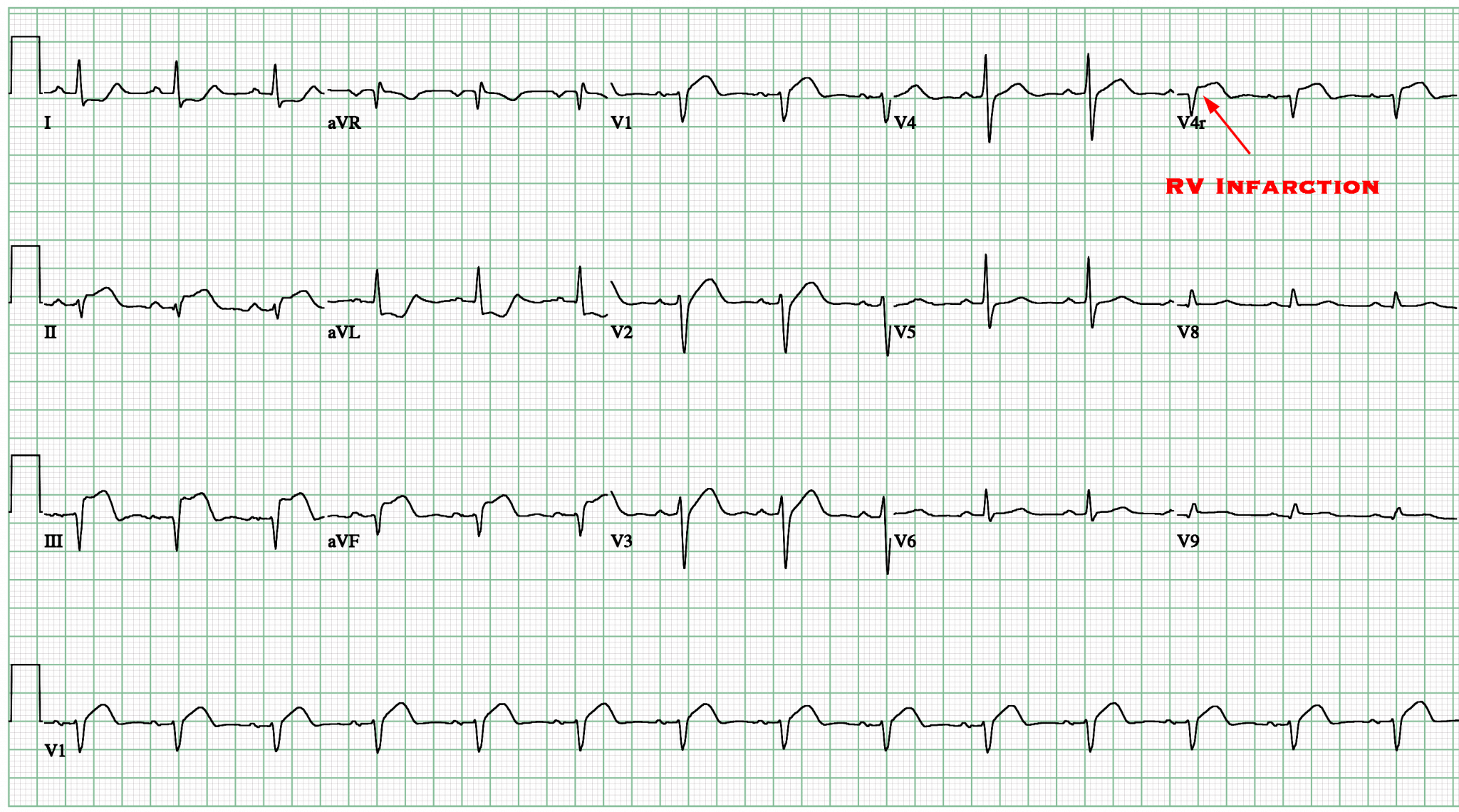 Complications Of Myocardial Infarction - Cardio Guide