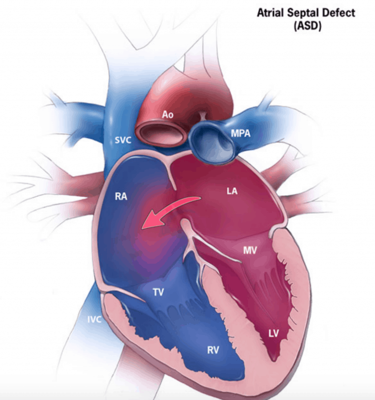 Atrial Septal Defect (ASD) – Cardio Guide