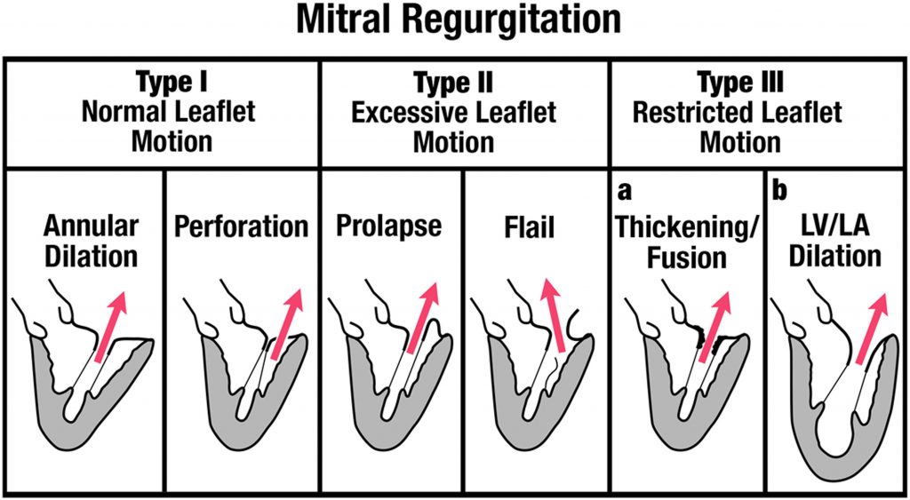 Mitral Regurgitation Cardio Guide