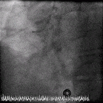 Read more about the article Inferior STEMI #1