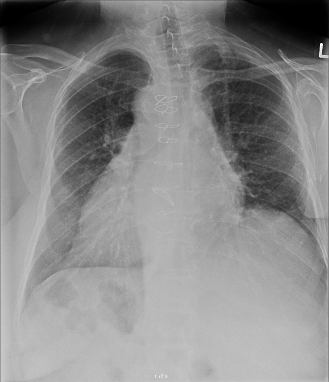 dextrocardia icd 10 cm