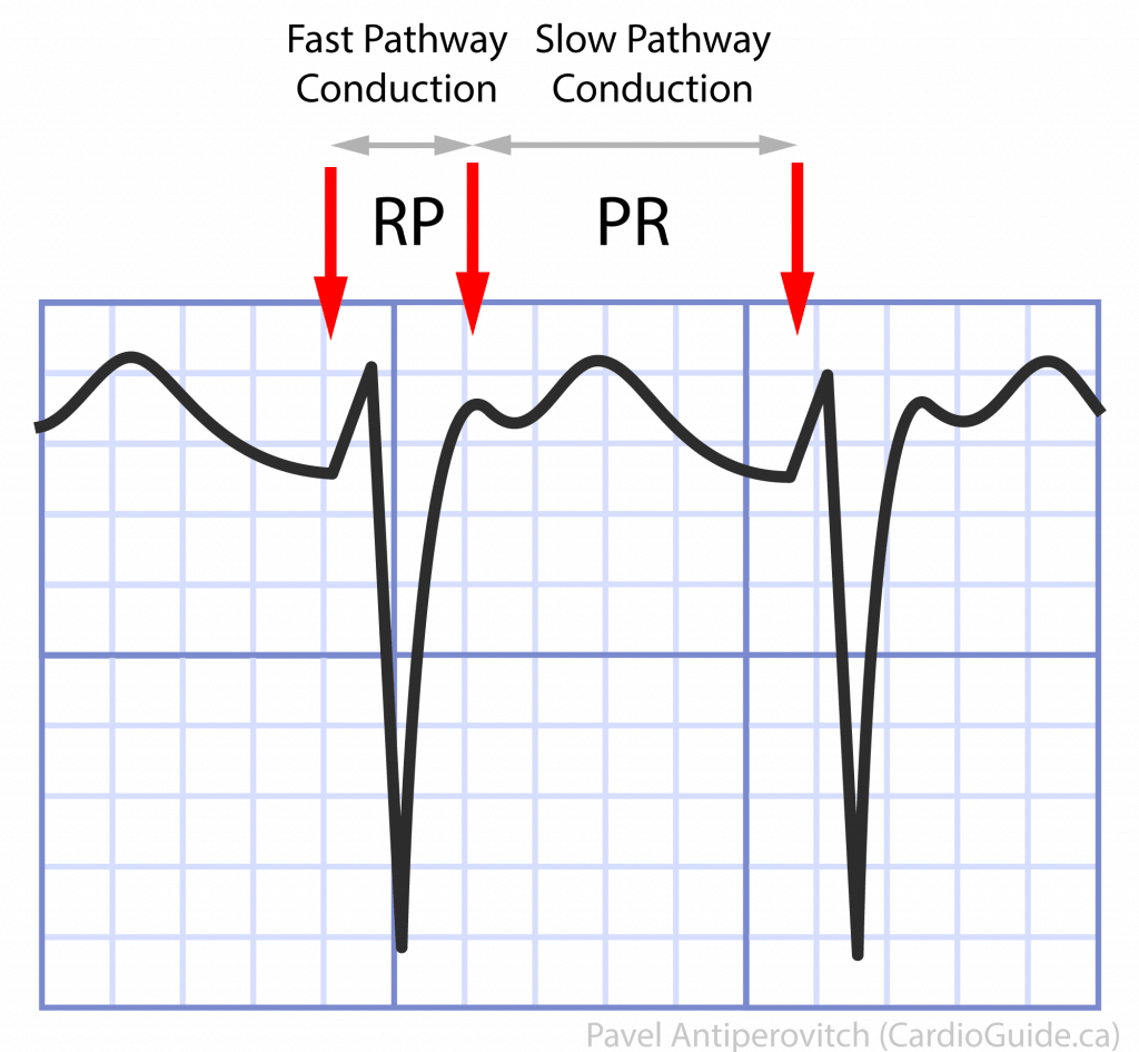 Narrow QRS Regular Tachycardia – Cardio Guide