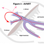 Read more about the article Narrow QRS Regular Tachycardia