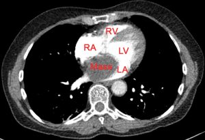 LA Myxoma - Cardio Guide