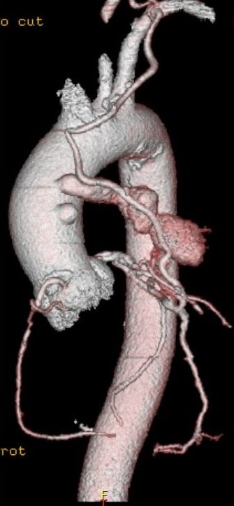 Download SVG Aneurysm - Cardio Guide