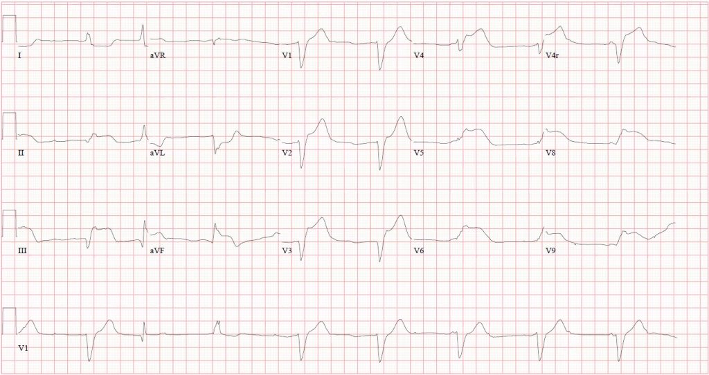 RV Infarct - Cardio Guide