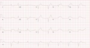 RV Infarct - Cardio Guide