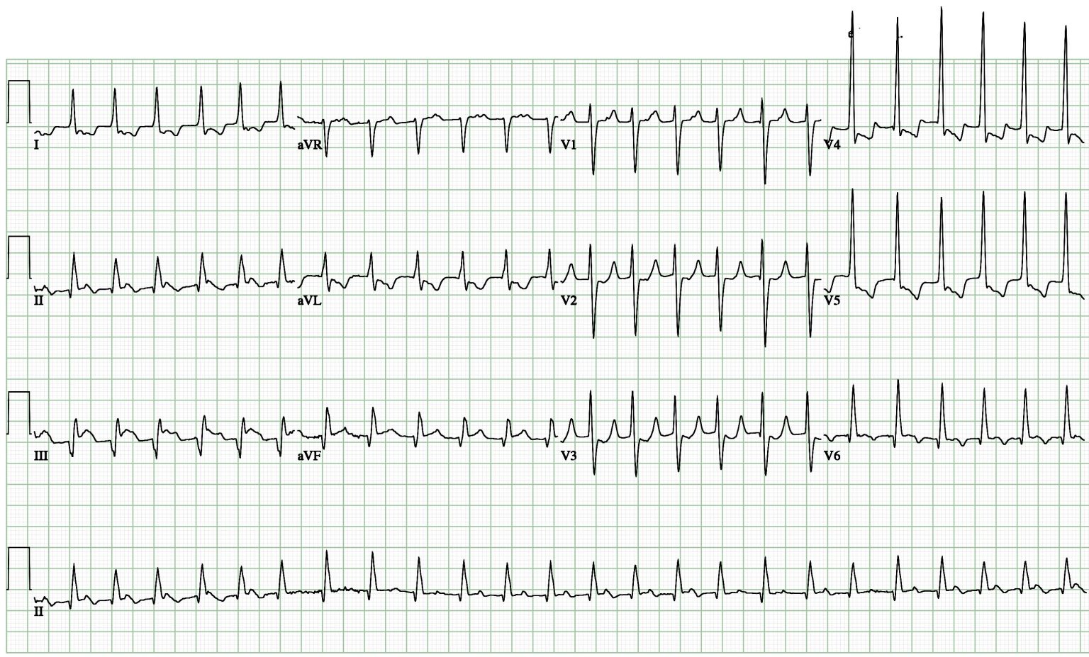 Narrow QRS Tachycardia – Cardio Guide