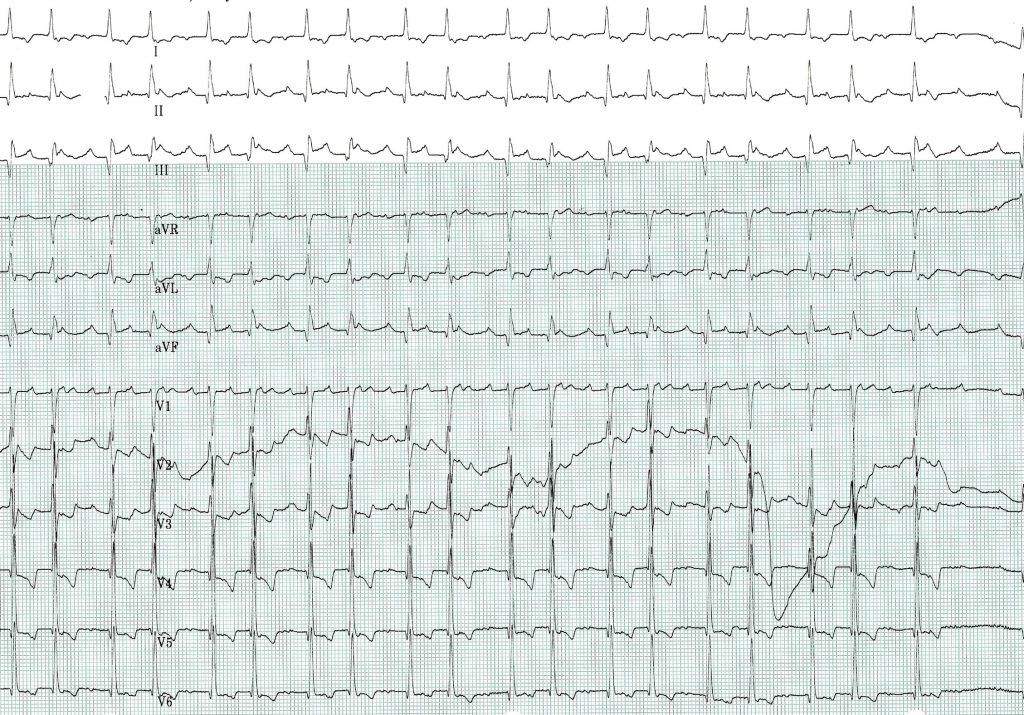 Narrow QRS Tachycardia – Cardio Guide