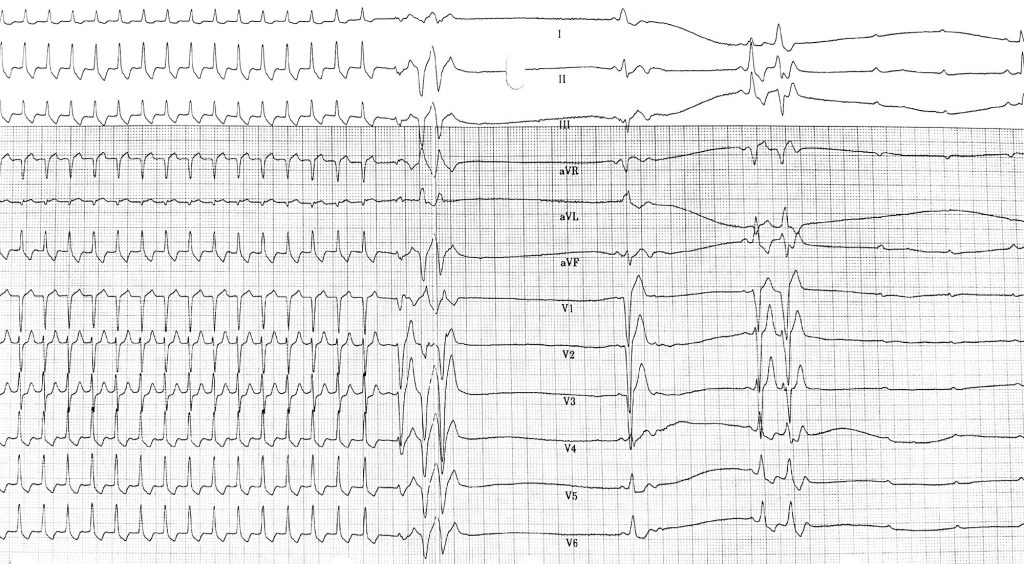 Narrow QRS Tachycardia – Cardio Guide