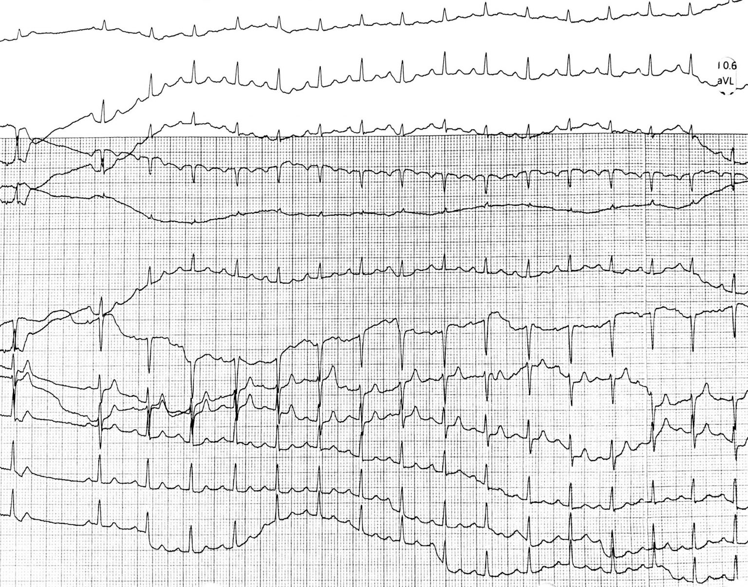 Narrow QRS Tachycardia – Cardio Guide