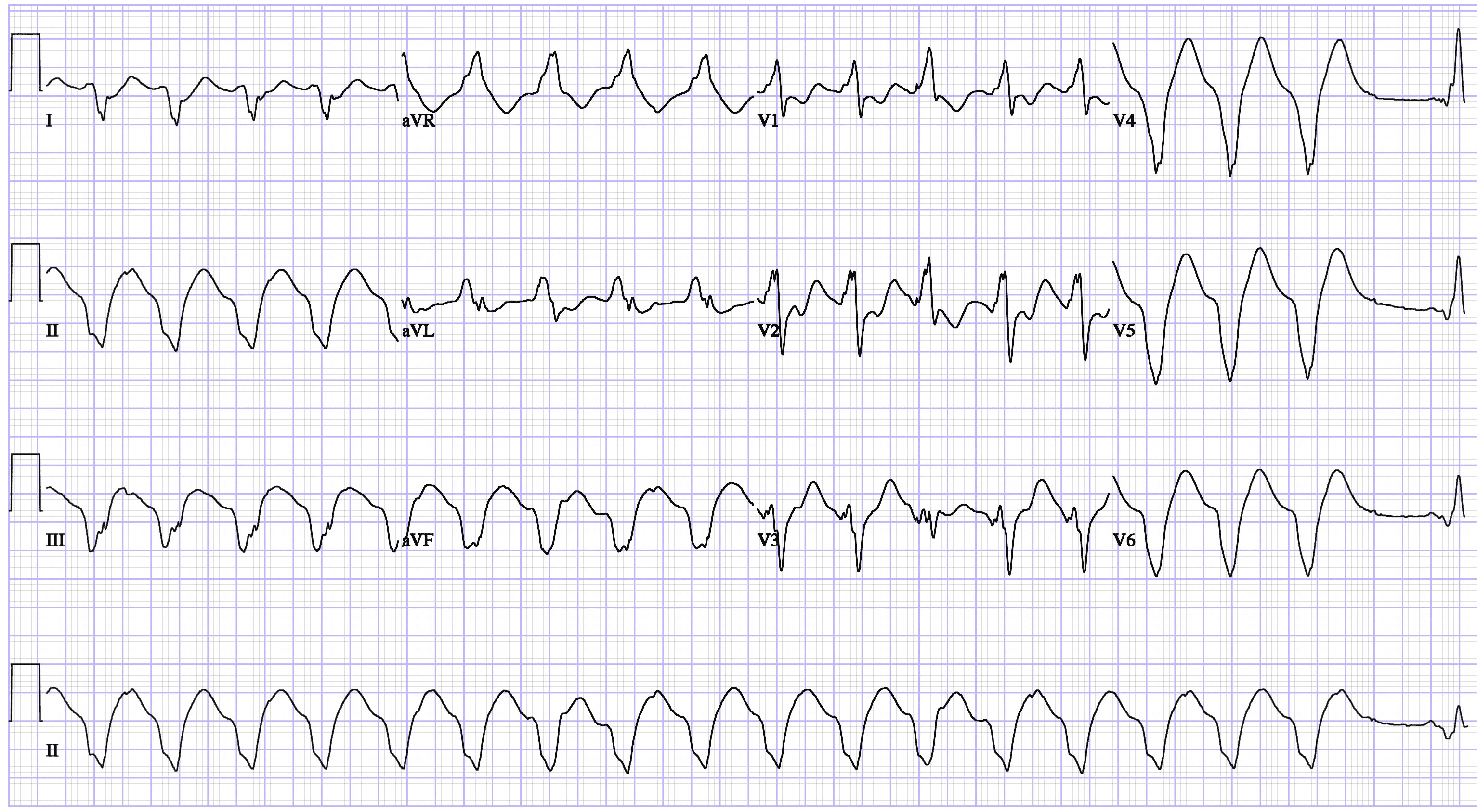 Тахикардия в покое. Желудочковая фибрилляция на ЭКГ. Крупноволновая фибрилляция на ЭКГ. Фибрилляция желудочков на ЭКГ. Трепетание желудочков на ЭКГ.