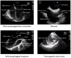 POCUS TEE - Cardio Guide