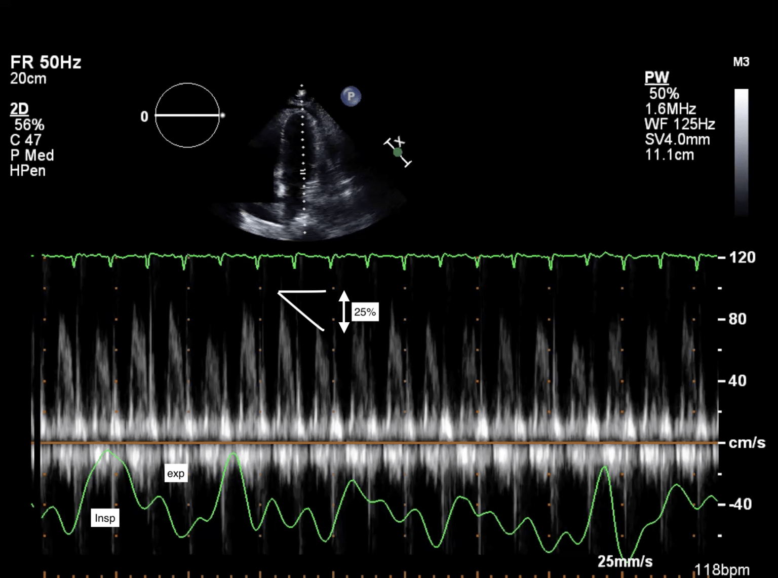 Cardiac Tamponade – Cardio Guide