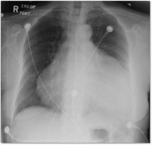 Cardiac Tamponade – Cardio Guide