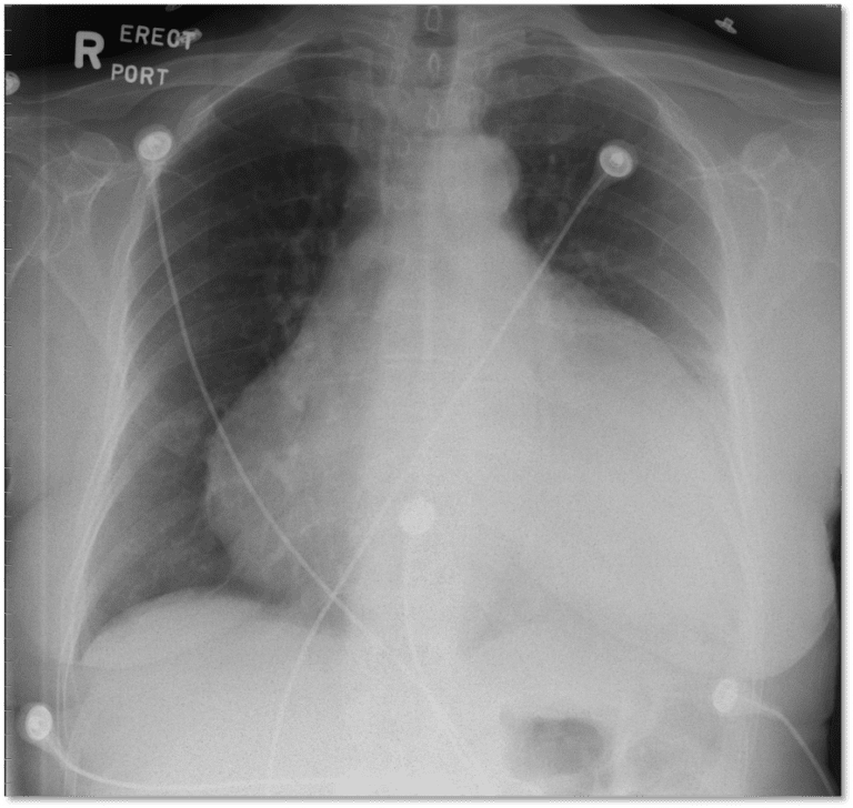 Cardiac Tamponade – Cardio Guide