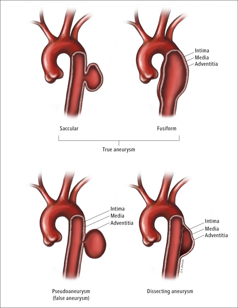 Aortopathy - Cardio Guide