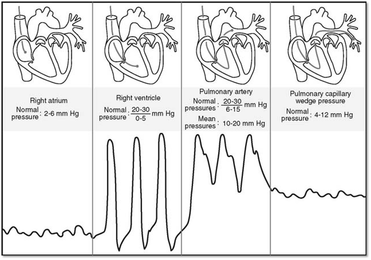 Pulmonary Artery Catheterization – Cardio Guide