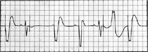 Temporary Pacing – Cardio Guide