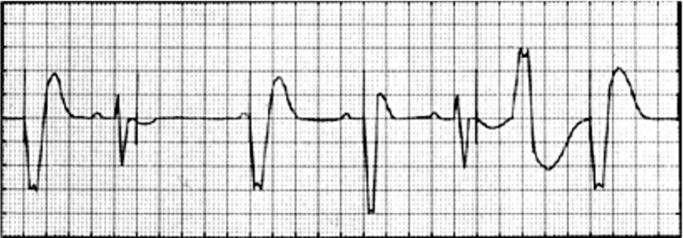 Temporary Pacing – Cardio Guide