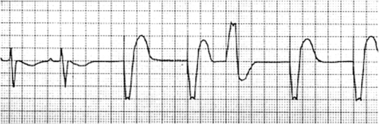 Temporary Pacing – Cardio Guide