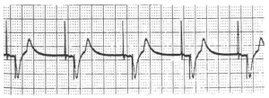 Temporary Pacing – Cardio Guide