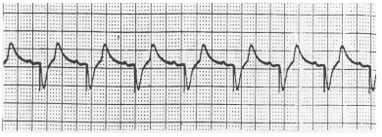 Temporary Pacing – Cardio Guide