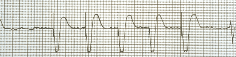 Temporary Pacing – Cardio Guide